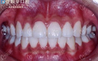 戴隐形牙套能踢足球吗，戴隐形牙套吃东西可以不摘吗